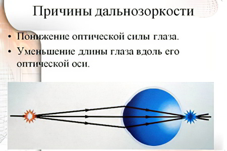 Причины дальнозоркости Причины дальнозоркости