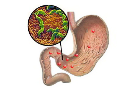 Причины хронического дуоденита Причины хронического дуоденита