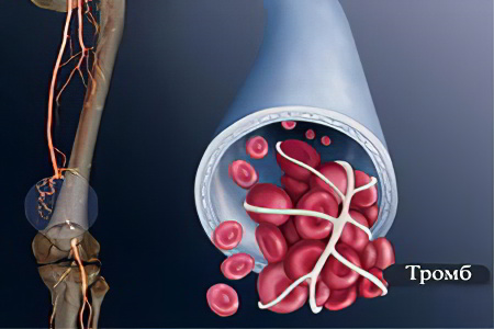Причины тромбоза Причины тромбоза