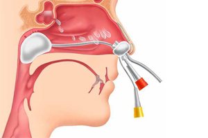 Проведение процедуры Проведение процедуры