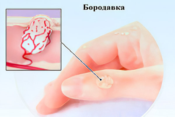 Как происходит заражение Как происходит заражение