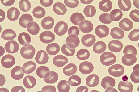 Простая гиперволемия Простая гиперволемия