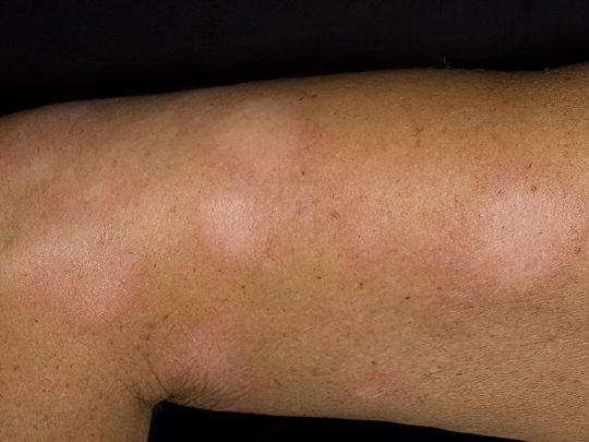 Простой (белый) лишай Простой (белый) лишай