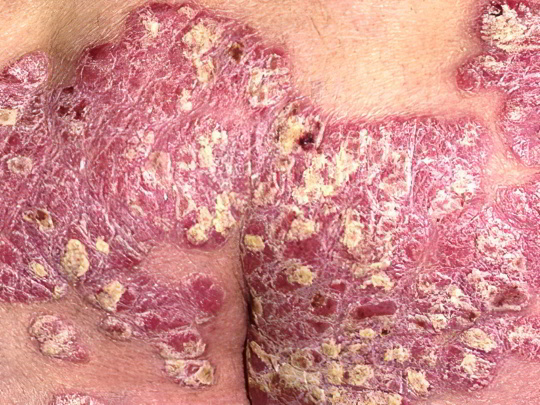 Псориаз Псориаз