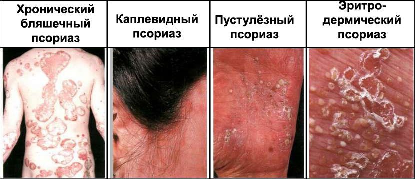 Симптомы псориаза Симптомы псориаза