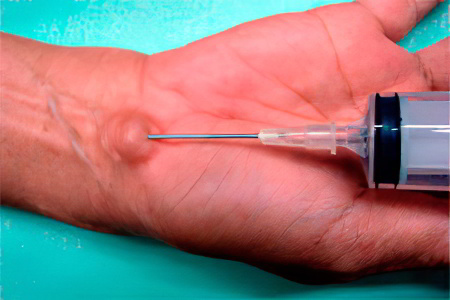 Пункция при гигроме Пункция при гигроме