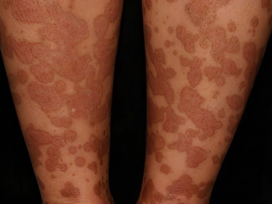 Поствоспалительная гиперпигментация Поствоспалительная гиперпигментация