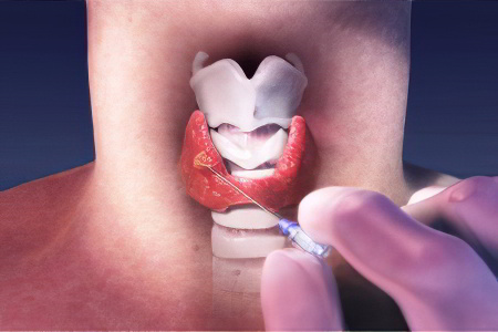 Пункция узла щитовидной железы Пункция узла щитовидной железы