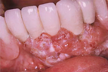 рак десны рак десны