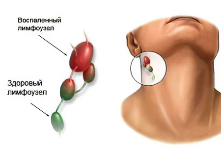 рак лимфоузлов рак лимфоузлов