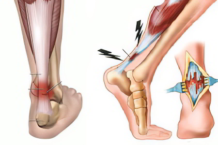 растяжение сухожилий растяжение сухожилий