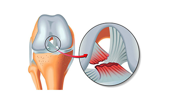 Разрыв связочного аппарата Разрыв связочного аппарата