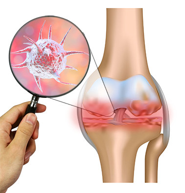 Реактивный артрит Реактивный артрит