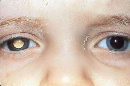 Ретинобластома Ретинобластома