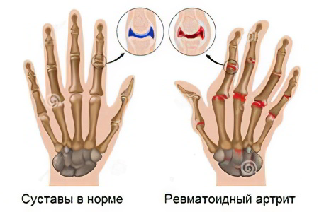 Ревматоидный артрит Ревматоидный артрит