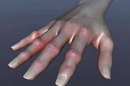 ревматоидный артрит ревматоидный артрит