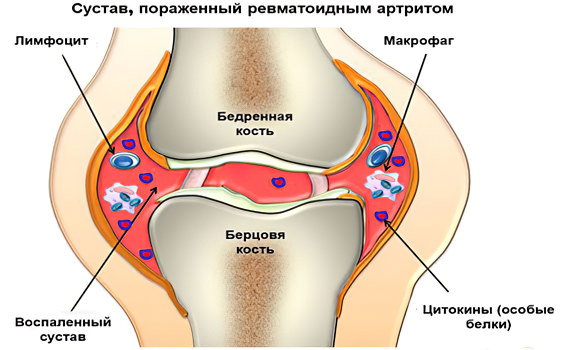 Ревматоидный артрит Ревматоидный артрит