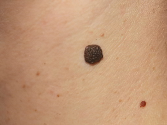 Невусы Невусы