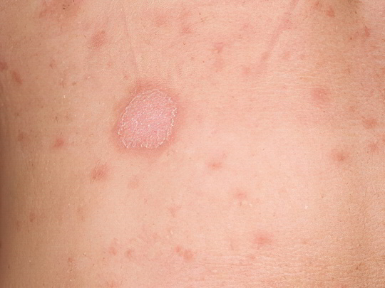 Розеола Жибера Розеола Жибера