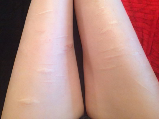 Рубцы Рубцы