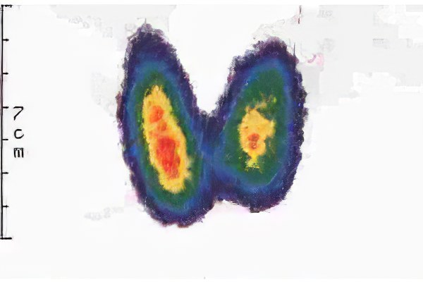 сцинтиграфия сцинтиграфия