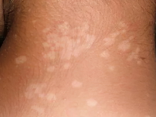 Сифилис Сифилис