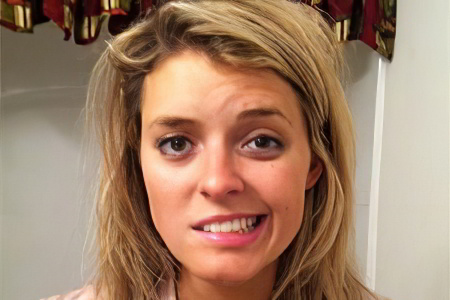 Симптомы пареза лицевого нерва Симптомы пареза лицевого нерва