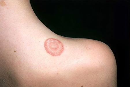 Симптомы лишая Симптомы лишая