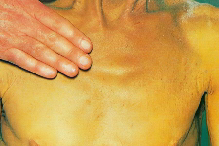 Симптомы механической желтухи Симптомы механической желтухи