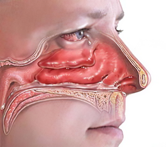 симптомы озена симптомы озена