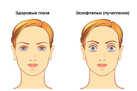 Симптомы экзофтальма Симптомы экзофтальма