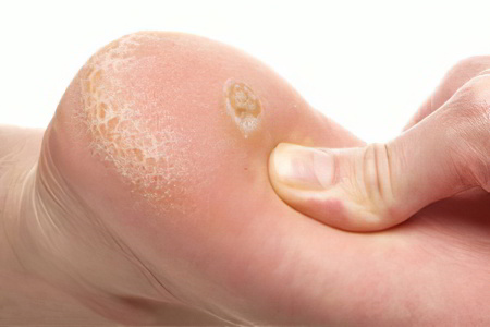 Симптомы сухой мозоли Симптомы сухой мозоли