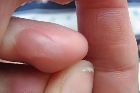Симптомы водяной мозоли Симптомы водяной мозоли