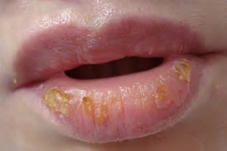 Синдром Россолимо-Мелькерссона Синдром Россолимо-Мелькерссона