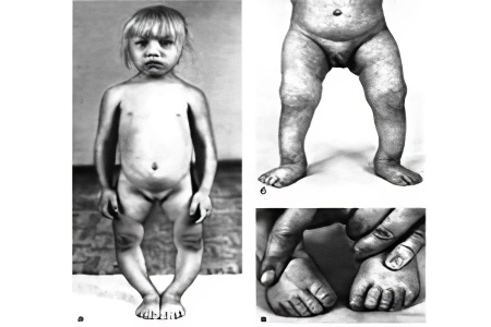 Симптомы синдрома Тернера Симптомы синдрома Тернера