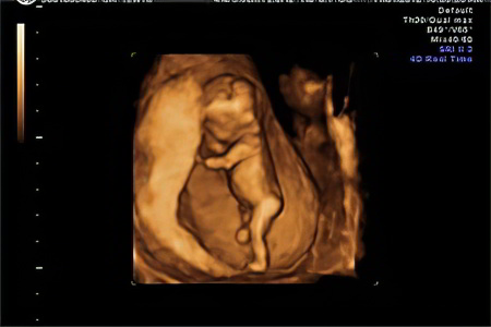 Скрининг Скрининг