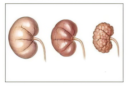 Стадии хронической почечной недостаточности Стадии хронической почечной недостаточности