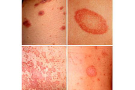 Стадии лишая у человека Стадии лишая у человека
