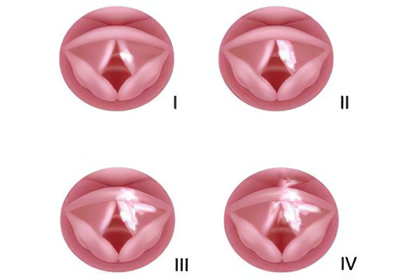 Стадии рака горла