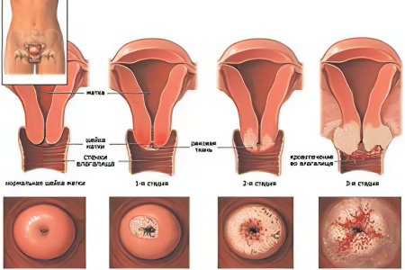 Стадии рака шейки матки Стадии рака шейки матки