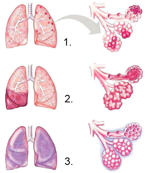 Стадии пневмонии Стадии пневмонии