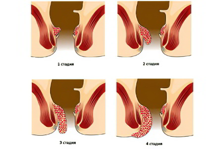 Виды и степени тяжести тромбоза Виды и степени тяжести тромбоза