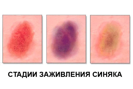 Стадии заживления синяка Стадии заживления синяка