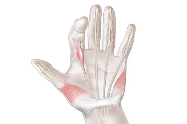 Стенозирующий лигаментит Стенозирующий лигаментит