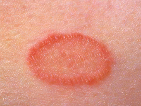 Стригущий лишай Стригущий лишай