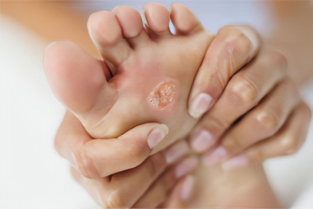 Сухая мозоль Сухая мозоль