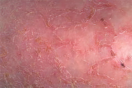 Сухой дерматит Сухой дерматит