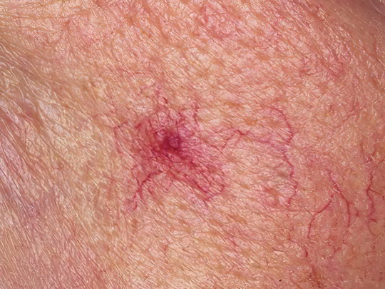 Телеангиэктазия Телеангиэктазия