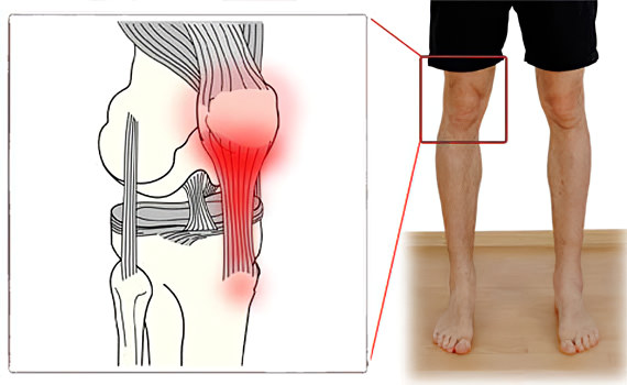 Тендинит Тендинит