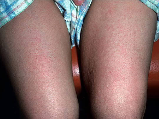 Токсикодермия Токсикодермия